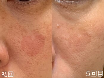 ハレオラ(HaleOla)/40代5回目☆毎日目につく○○も