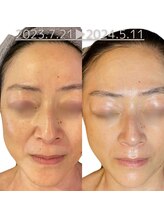 ラリマ(La-lima)/50代女性/たるみケア/ほうれい線