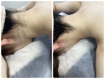 ルルトウキョウ 池袋店(LULU.tokyo)/うなじ脱毛