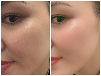 桜/シミケアBeforeAfter