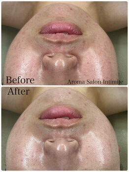 アンティミテ(Intimite)/パーソナルスキンケアコース