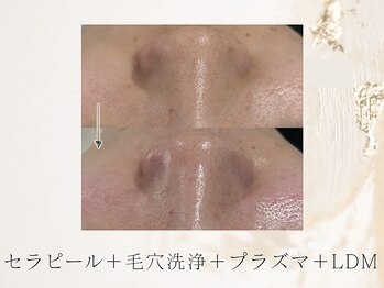 アネラボーテ(Anela Beaute)/ピーリング×LDM毛穴開き改善◎