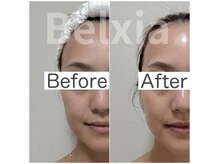 ベルシア(Belxia)/陶肌ピール 1回の効果