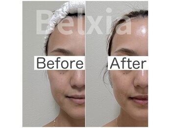 ベルシア(Belxia)/陶肌ピール 1回の効果