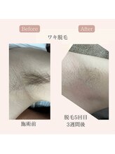 リードエピア(LEADepiA)/臭い対策に「ワキ脱毛」は常識♪