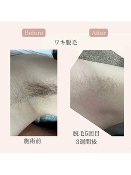 リードエピア(LEADepiA)/臭い対策に「ワキ脱毛」は常識♪