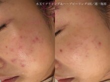 サロンヴェアリー 広尾(salon vary)/お急ぎブライダル！#ニキビケア