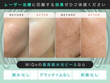 バグジーエピ(BAGZY EPI)の雰囲気（WiQo水光ピール導入しました！）