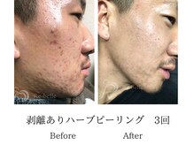 メンズミーシェ(Men's Meshie)/リベルハーブピーリング施術後