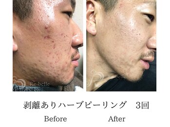 メンズミーシェ(Men's Meshie)/リベルハーブピーリング施術後