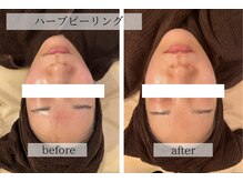 スタジオフラフィー(studio Fluffy)/施術画像｜ハーブピーリング