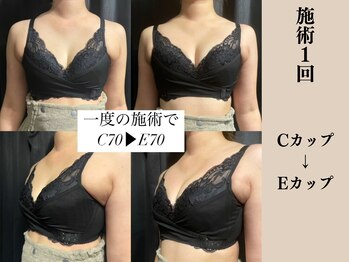 ソワ(soie)/1度の施術で2カップもUP