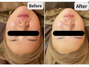 ブプラ 池田店(BUPURA)/水光肌 小顔 シワ たるみ 美白