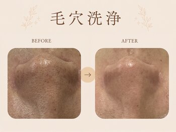 カノン 南熊本店(Kanon)の写真/【本荘/男女OK◎】韓国最新美容で最強艶肌＊*ララピール￥8,800～/セルフホワイトニング初回￥3,900