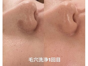 リアン(Lien)/毛穴洗浄ハイドロスプラッシュ