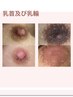 【ローマピンク】乳首＆乳輪22万→40％割13,2万円黒ずみ除去