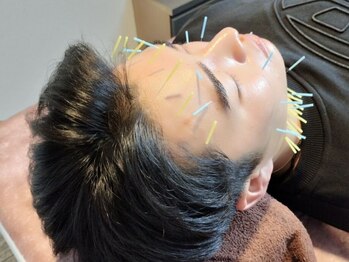 鍼灸院ネクストステップ(鍼灸院NextStep)の写真/頑固な肌荒れにお悩みの方へ!!《メンズ限定★美容鍼¥2,200》ほうれい線改善・理想のフェイスラインに導く♪