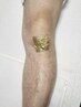 「ボディーの負傷・動きにくい所」痛みが我慢できない方金箔施術100分¥14,500