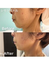 デディア 恵比寿(dedia)/レモンボトルでたるみ一挙解決