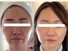 ジョーヌ(JAUNE)/ほうれい線改善！