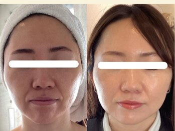 ジョーヌ(JAUNE)/ほうれい線改善!