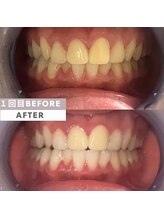 ビューティリュクス(beauty luxe)/脱マスク！セルフホワイトニング