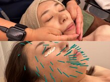 はしもと鍼灸整骨院/ラジオ波　美容鍼灸