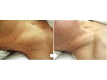 サロンドエステケイワイ(de KY)/フェイシャル☆首の濃いシミ改善