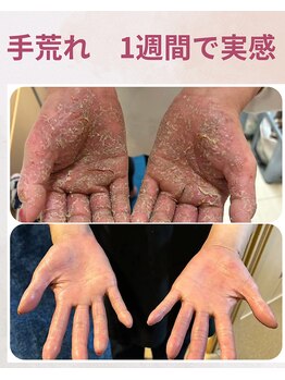 ララスマイル 鶴崎森町店/手荒れが綺麗になりました