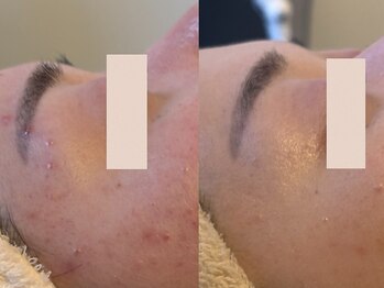 アン(An)/ニキビケア