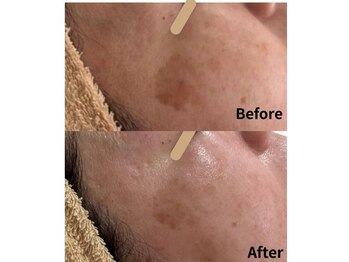 グロウスキン(GROW SKIN)/★シミ気の変化