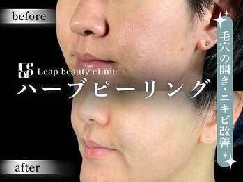 リープ(Leap)/ハーブピーリング