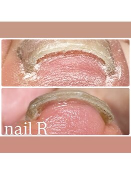 ネイルアール(nail R)の写真/美爪へ導くプロ！角質除去はお任せ下さい◎巻き爪矯正で足のお悩みも解決♪
