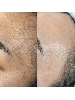 スイ 四条烏丸(SUI)/〇全顔シェービング