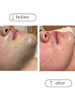 フルールスレーヌ(Fleur Sereine)/清潔感が一番☆本気の髭脱毛