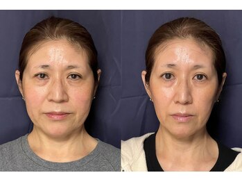 美容整体 アルマ/小顔矯正15回目