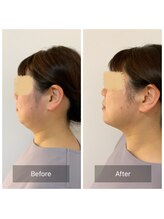 チル(Chill.)/小顔リフト整顔 4