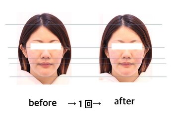 ワンネス 平林店(One’Ness)/顔肉、むくみも即効小顔◎