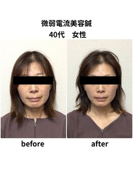 ビハダ(BIHADA)/微弱電流美容鍼　Before/After