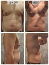 ヴィトワ(Vitowa)/ウルトランスフォーマー施術例15