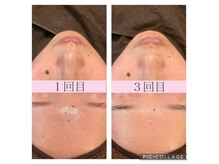越前屋の雰囲気（ハイドロフェイシャル3回）
