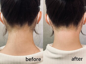 アイブロウサロン アヴィ(A‘VI)/うなじ襟足　光×ワックス脱毛