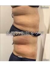 ルキア(LUKIA)/痩身【脂肪冷却】症例３　おなか