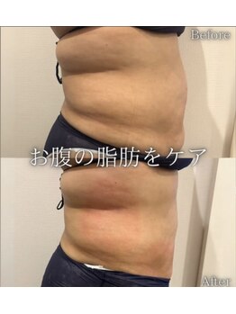 ルキア(LUKIA)/痩身【脂肪冷却】症例３　おなか