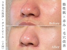 ゼアー(THERE FY.)/何をしても効果のなかった赤みに