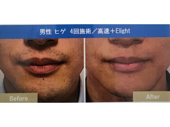 クローバー(clover)/ひげ脱毛