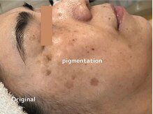 オアシスラグーン(OASIS LAGOON)/シミケア（症例５：before）