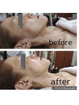 クリオネ(Clione)/BBL光フェイシャル通常の効果5倍