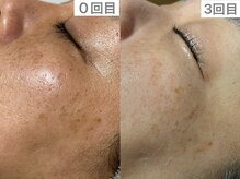 ユイット ルッカ(Huit Lucca)/ララピール×アクアダーマ