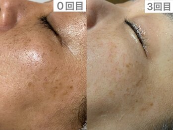 ユイット ルッカ(Huit Lucca)/ララピール×アクアダーマ